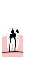 TOOTHDEC.CGM