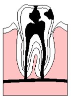 TOOTHDEC.TIF