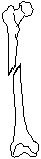 Leg - Oblique Fracture.eps