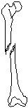 Leg - Spiral Fracture.eps