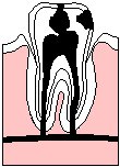 Tooth Decay.eps