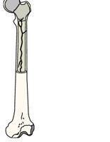 BONE.CGM