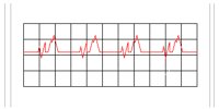 EKGCHART.PCT