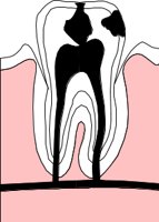 TOOTHDEC.CMX