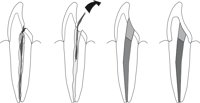 ROOTCANL.CMX