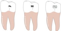 MOLARFIL.CMX