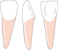 INCISOR.CMX
