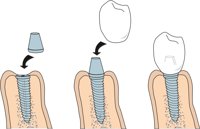 IMPLANTS.CMX