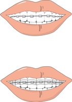 BRACES.CMX
