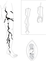 VARICOSE.CMX