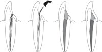 ROOTCANL.CMX