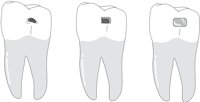 MOLARFIL.CMX