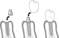 IMPLANTS.CMX