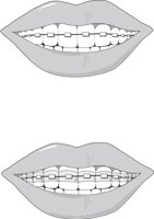 BRACES.CMX