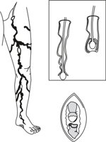 VARICOSE.CMX