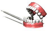 tartarteeth_cleaningg_a_mw.gif