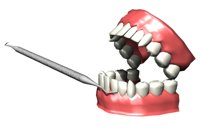 tartarteeth_cleaningg_a_hr.jpg